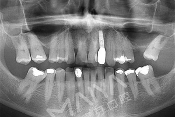 深圳種植牙手術需要多長時間?