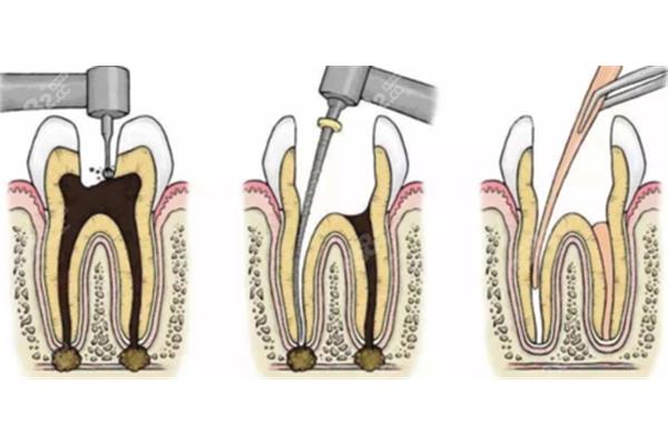 根管治療牙齒壽命多久? 做根管治療可以管多久
