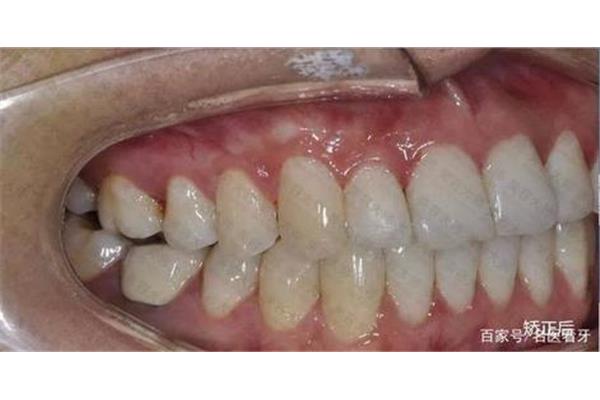 拔牙后多久才能鑲牙?一般情況下不會影響咀嚼功能