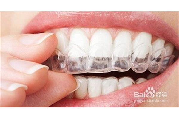 一般牙套要帶多久取決于牙齒問題類型