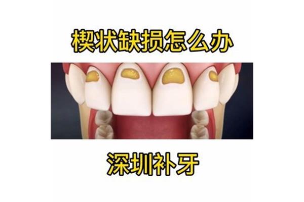 補牙要用多長時間? 牙齒楔形缺損補牙多少錢