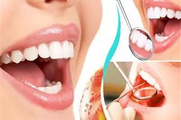 一文看懂!洗牙后牙齒酸痛怎么辦?怎么修復?