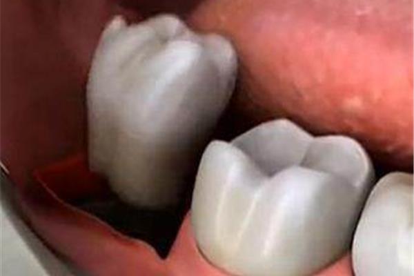 智齒拔掉后多久牙齦會腫?牙齦腫痛多久能止住?