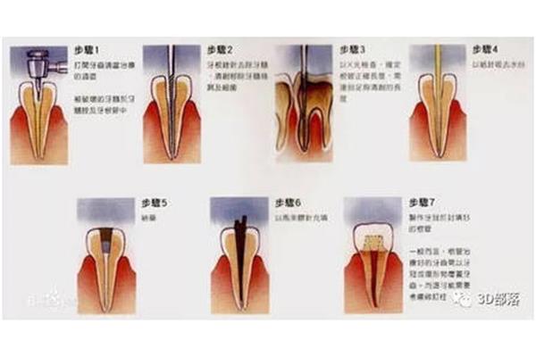 什么時候需要做牙齒根管治療?