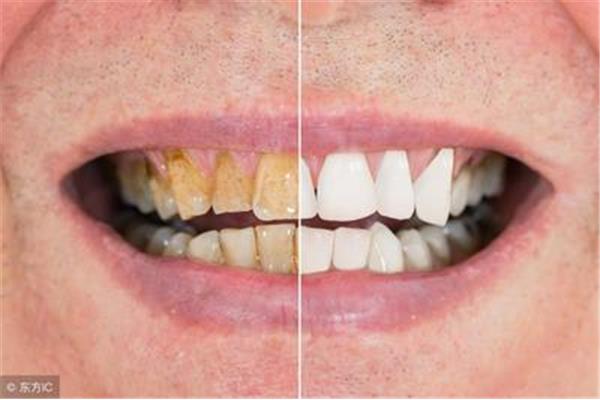 牙齒美白后多久可以洗牙,牙齒怎么才能白?