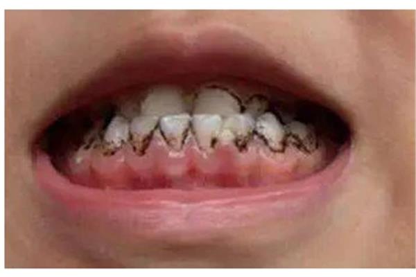 小孩牙齒如何矯正? 矯正鎖頜橡皮筋要戴多久