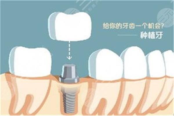 種牙需要多長時間?一般來說需要4到6個月