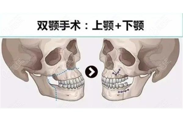 嘴巴突出也叫作雙頜前突需要矯正嗎?