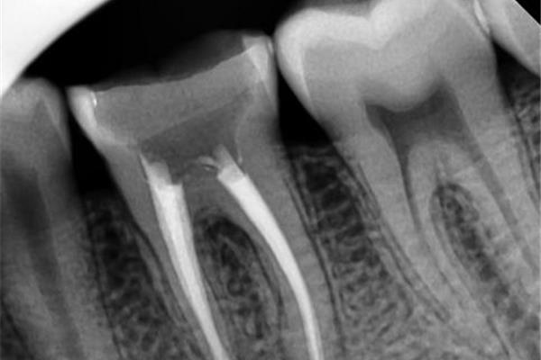 牙齒根管治療需要多久? 做根管治療需要多長時間