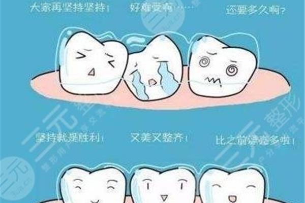 兒童牙齒矯正需要多久?一般需要1.5年到3年