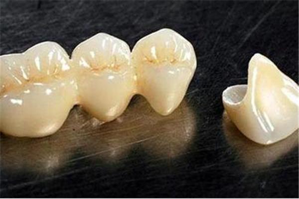 單顆牙套能用多久