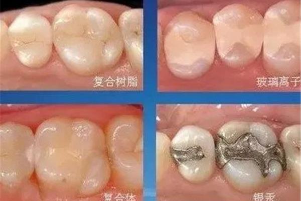 補牙玻璃離子能用多久