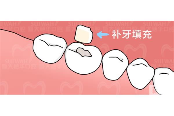 牙齒斷裂補牙需要多久