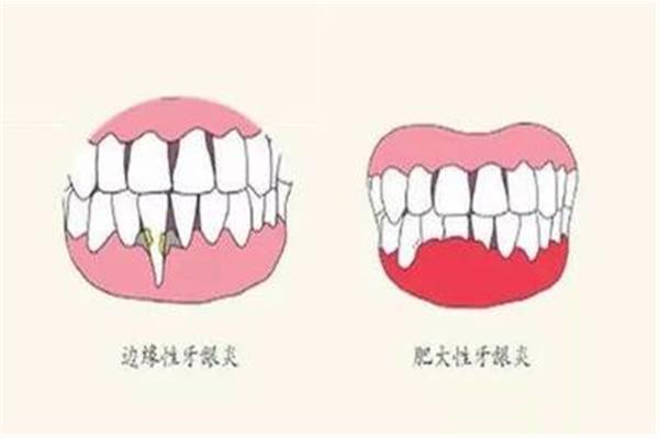 牙齦炎怎么辦?正確刷洗牙齦邊緣可防止牙齦發炎