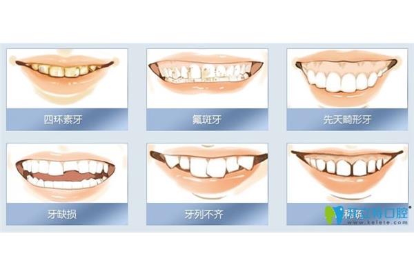 用陶瓷牙套矯正牙齒需要多長時間?牙套可以摘下來嗎?