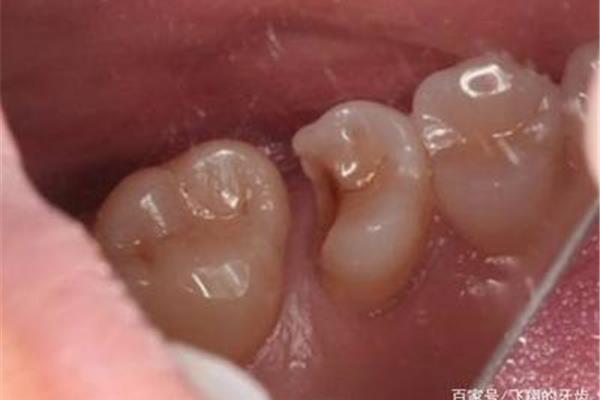 補過牙齒能用多久?專家:因多方面影響