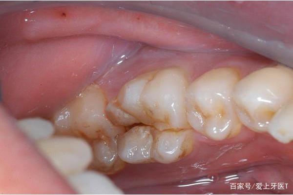 牙槽窩一般三個月左右可長平恢復正常