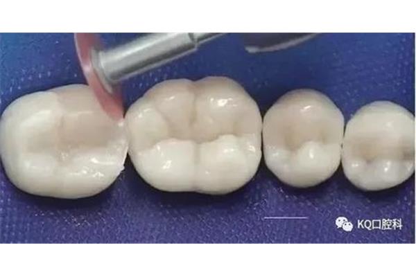 補牙注意事項多 補牙一般能維持多久?