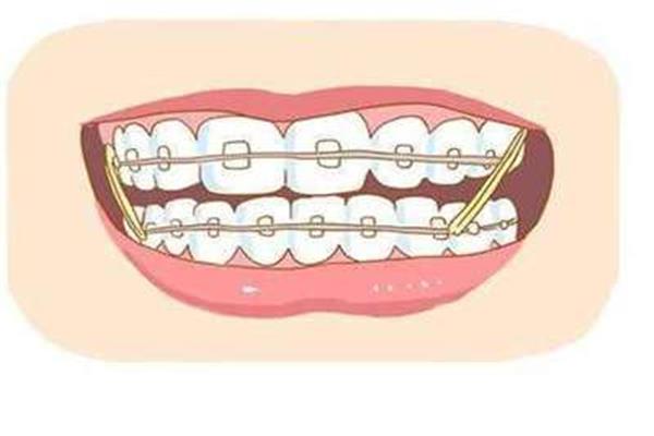 牙科正畸橡皮圈多久換曾經,戴正畸橡皮筋要多久?