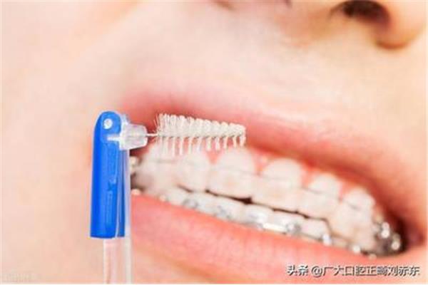 成年人牙齒矯正需要多久?專家:兩點影響因素有關