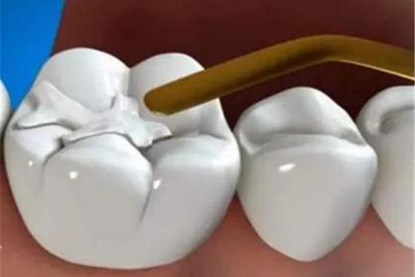 補牙一般要用多長時間?根據個人牙齒狀況決定