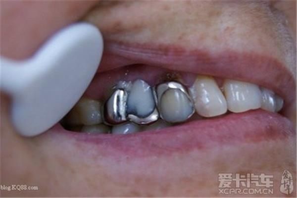一般情況下鑲的牙可以維持多久?