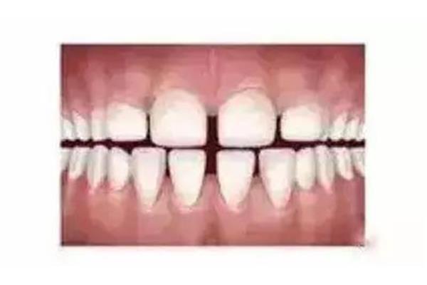 拔牙后多久可以鑲牙?一般2個月左右鑲牙