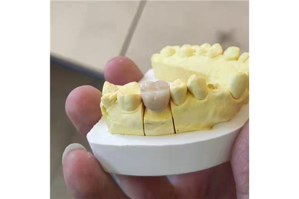 一顆假牙能用多久