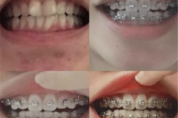 口腔內收是什么意思? 牙內收需要多久