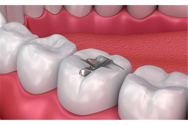 牙齒補過后能使用多久? 氫氧化鈣牙齒填充物能用多久