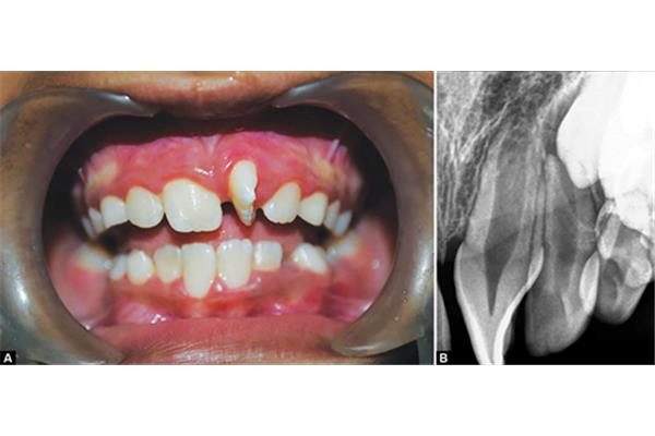 牙齒為什么會扭曲?烤瓷牙修復一般需要多長時間?