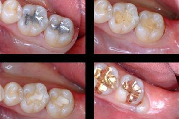 蛀牙補個洞一般要多久,能持續多久?