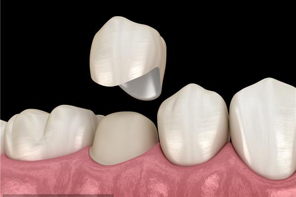 牙齒美容冠可保持多久? 兒童金屬牙冠能用多久