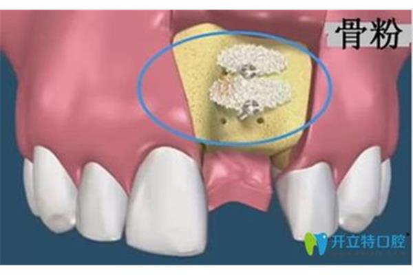 填充骨粉后種植牙需要多久愈合,做種植牙需要多久?