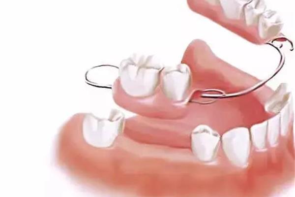 牙齒松動怎么辦?牙醫教你如何正確鑲牙?