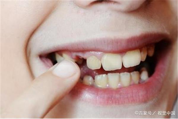 補牙后能維持多久?專家給出幾個因素的分析