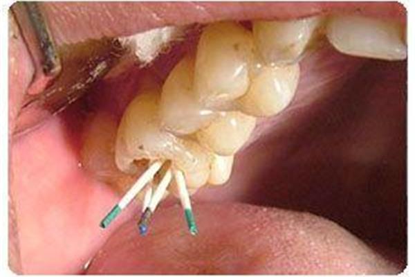 大牙根管治療要多久