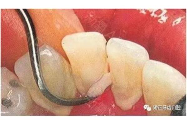 牙周炎怎么治療多久