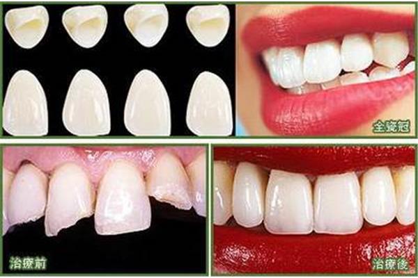 補過牙齒使用壽命有多長? 門牙掉了補牙要多久