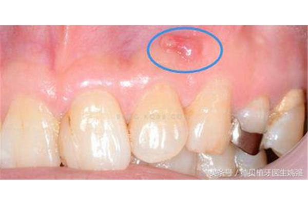 牙齦長膿包可以自己治療嗎?牙齦有膿包怎么辦?