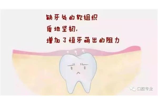 關于拔牙的五個問題 拔完牙多長時間能吃飯
