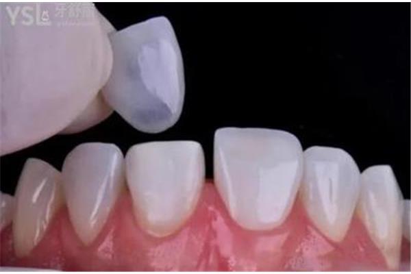 直接貼面修復怎么做好? 補牙貼面修復能管多久
