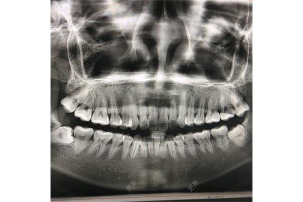 牙齒拍片和胸片哪個輻射大?