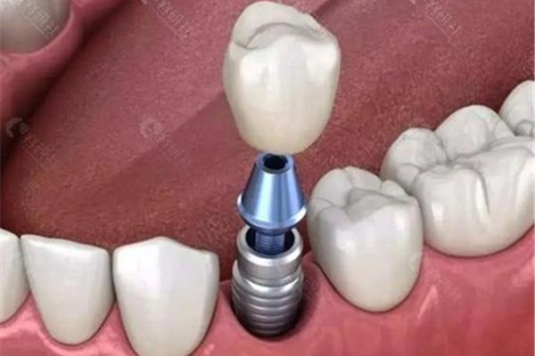 拔牙后多久可以做種植牙? 下頜種植修復需拔牙后多久進行