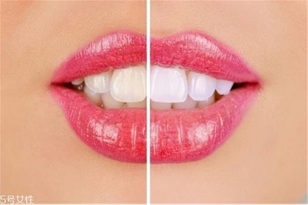 冷光牙齒美白可維持多久?一般情況可持兩年