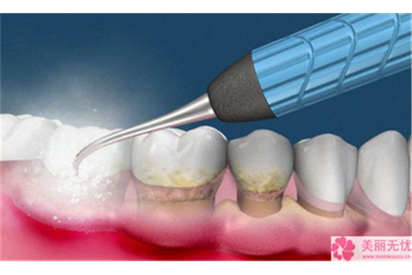 一般洗牙噴砂能堅持多久,超聲波洗牙能堅持多久?