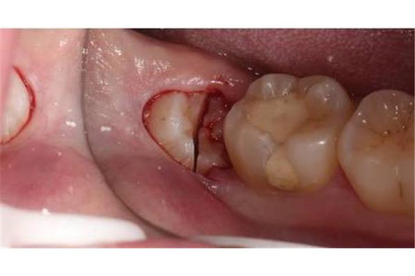 拔牙后需要多長時間能恢復?一般需一周到十天