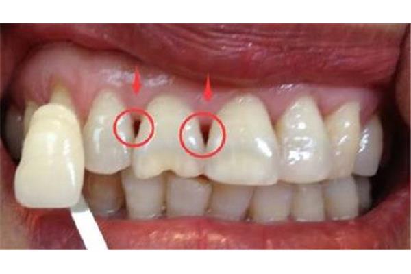 牙齒矯正要多久見效果?一般情況因人而異