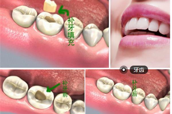 補牙洞能維持多久?材料能堅持多長時間?