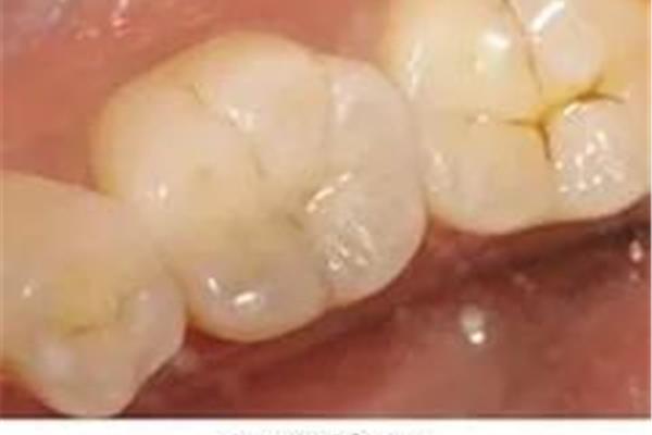 補牙材料固化多久
